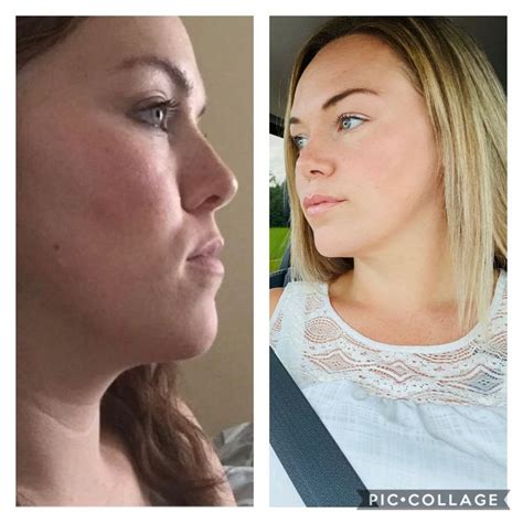 Before And After Double Jaw Surgery Nose Surgery Rhinoplasty Jaw