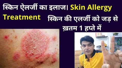 Acupressure Points For Skin स्किन ऐलर्जी का इलाज । Skin Allergy