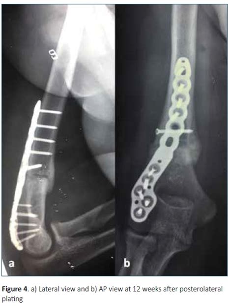 Fixation Of Extra Articular Distal Humerus Fractures With A Single Posterolateral Plate