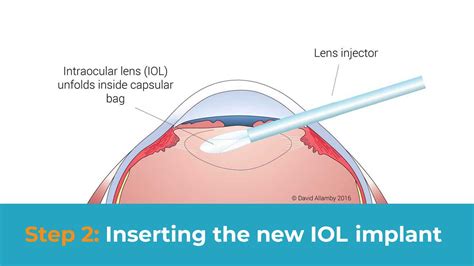 cataract surgery a complete guide for everything you need to know