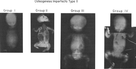 Radiographs Of Infants With Oi Type Ii Groups I 82 145 Ii 82 127