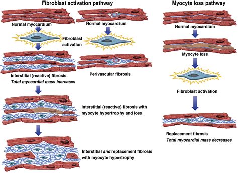 Myocardial Scar And Fibrosis Heart Failure Clinics