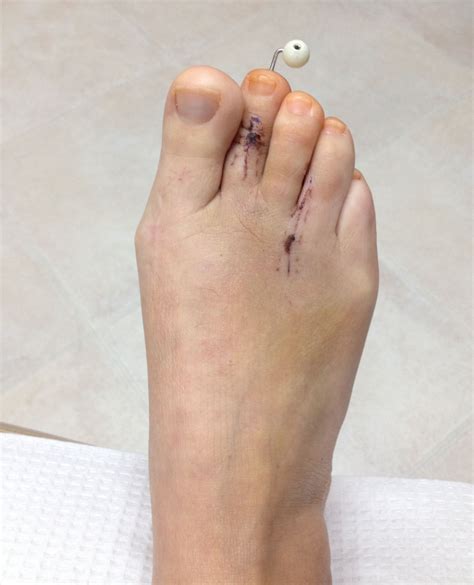 Cosmetic Foot Surgery Near Me Kicosmetic