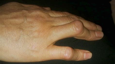 Rheumatoid Arthritis Hand Deformities What To Do