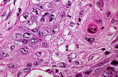 Filewell Differentiated Squamous Cell Carcinoma Wikipedia