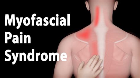 Myofascial Pain Syndrome And Trigger Points Treatments Animation