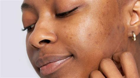 Real Acne Scarring How To Get Rid Of Your Acne Scars Hero Cosmetics