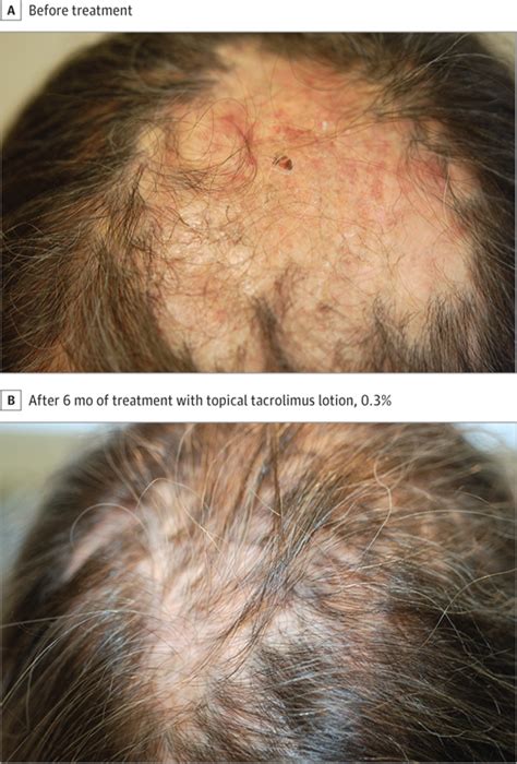 Treatment Of Scarring Alopecia In Discoid Variant Of Chronic Cutaneous