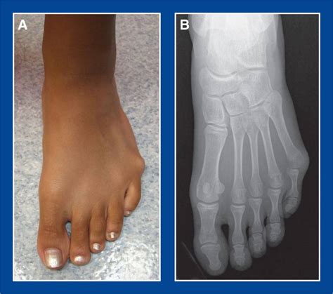 Toe Deformities Foot And Ankle Deformities Principles And