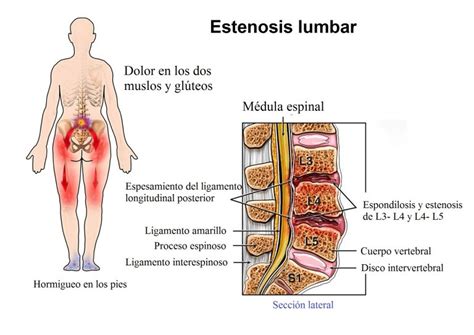 Estenosis del canal lumbar síntomas ejercicios y tratamiento