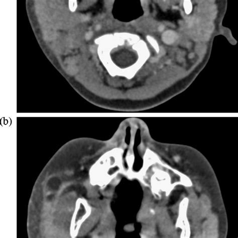 A Axial Ct Scan Of The Parotids With Iodinated Contrast Demonstrates