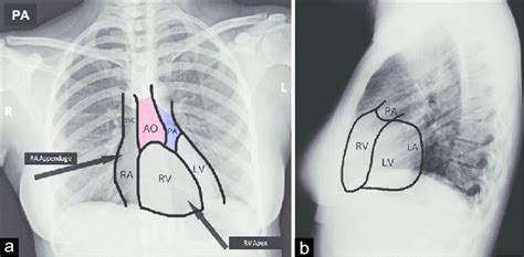 Normal Chest Pa And Lat Radiographic Views Chest X Ray A Download Scientific Diagram
