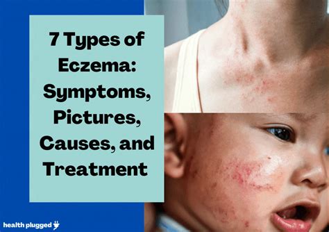 7 Types Of Eczema