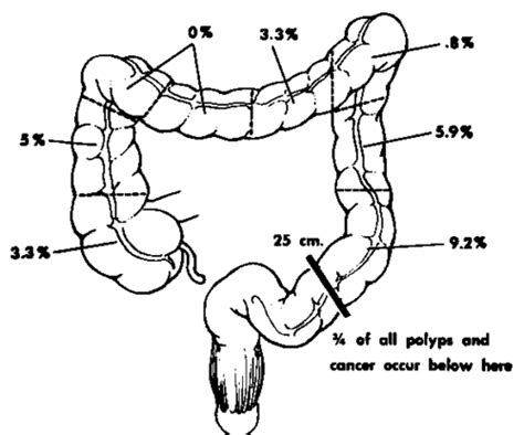 Distribution Of Polyps Of The Rectum And Colon