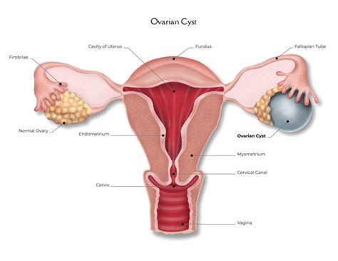 Adnexal Masses And Ovarian Cysts Surgery A Comprehensive Guide Coach