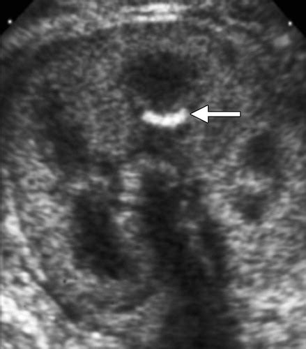 Renal Pyramids Ultrasound