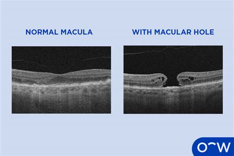 Macular Hole In The Eye Definition Causes Symptoms Diagnosis And