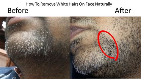 Treatment Of White Hairs On Face Permanently Youtube