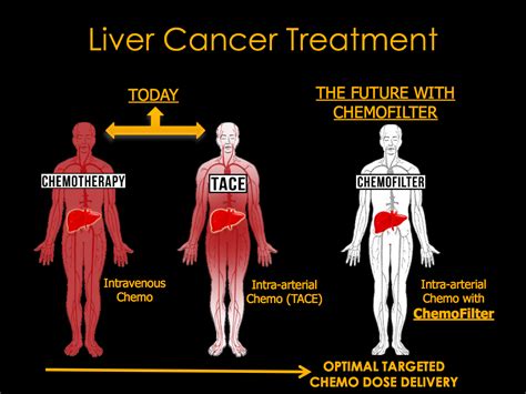 Liver cancer does not occur all of a sudden. Drug sponge could minimize side effects of cancer ...