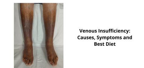 Venous Insufficiency Treatment Archives Daily Health Cures