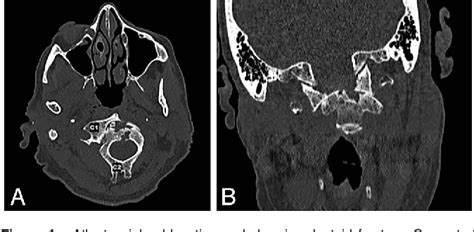Figure 1 From Traumatic Atlantoaxial Lateral Subluxation With Chronic