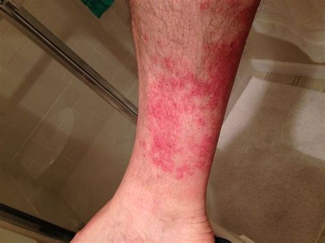 10 ways to get rid of rash on legs howhunter in 2021 leg rash home remedies for rashes