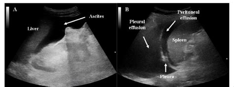A Ascites In A Patient With Hepatic Cirrhosis B Peritoneal And