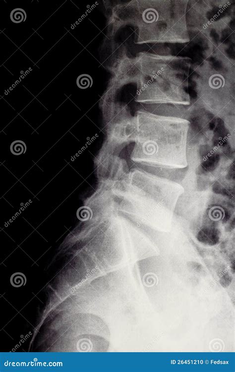 X Ray Of The Lumbar Spine With Herniated Disc Stock Photo Image 26451210