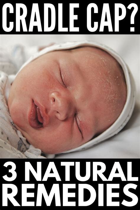 Cradle Cap 101 3 Natural Cradle Cap Remedies That Work Cradle Cap