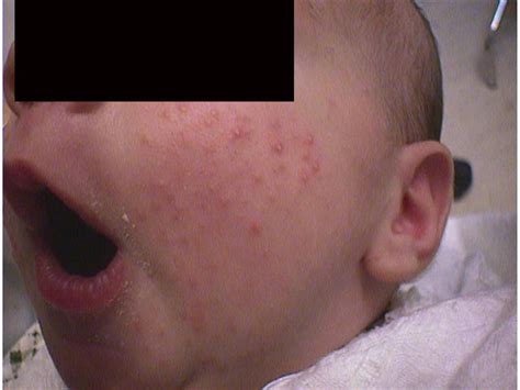 Diseases Of The Sebaceous Glands Acne Infantile Picture Hellenic