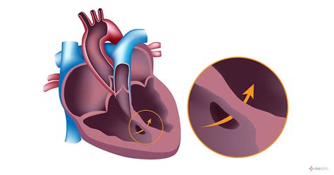 Holes In The Heart Treatment Symptoms Causes And Risk Factors