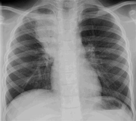 Learn about causes, risk factors, prevention, signs and symptoms. Community Acquired Pneumonia