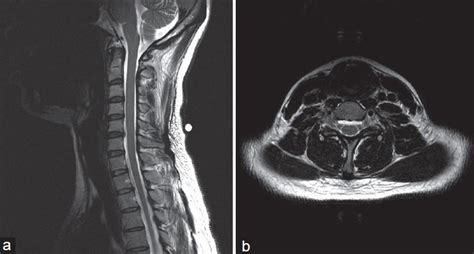 Presenting T Weighted A Sagittal And B Axial Cervical Mri Download Scientific Diagram