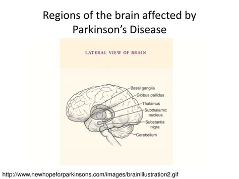 Parkinson's disease is a progressive nervous system disorder that affects movement. PPT - Conditions & Diseases Affecting Sensation and Motor Control PowerPoint Presentation - ID ...