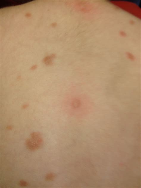 Derm Dx Multiple Papules On The Back Since Infancy Clinical Advisor