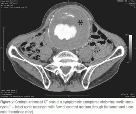 Ruptured Abdominal Aortic Aneurysm 26102012
