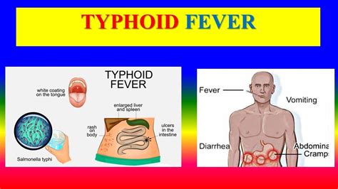 TYPHOID FEVER Definition Incidence Pathophysiology Clinical