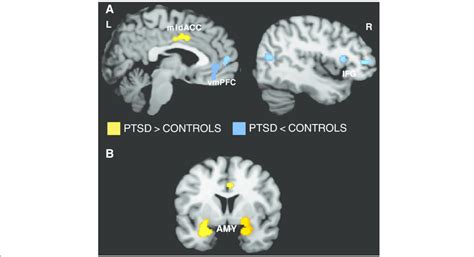 A Brain Regions Associated With Ptsd Across Symptom Provocation And
