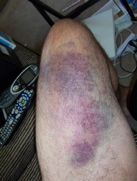 The Thigh Bruise Update Dan Langille S Other Diary