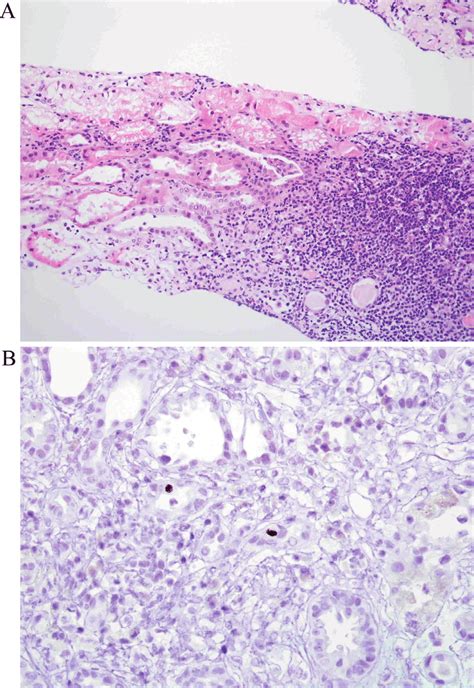 Cmv Nephritis In Transplanted Kidney Focal Interstitial Inflammation