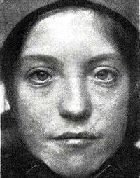 Le syndrome de kiss vient de l'allemand kopfgelenk induziert symetrie störungen qui signifie en français troubles de symétrie induits par les vertèbres cervicales. Facial morphology of Waardenburg syndrome
