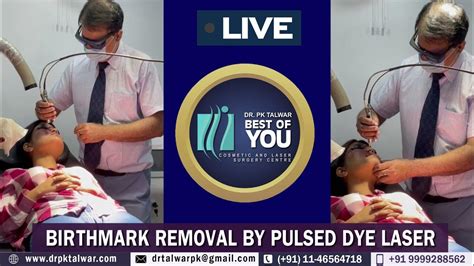 Live Birthmark Removal Treatment By Pulsed Dye Laser In Delhi India