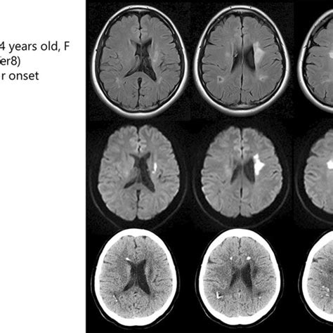 Brain Mri And Ct Findings Of Alsp Patient With The Frameshift Mutation