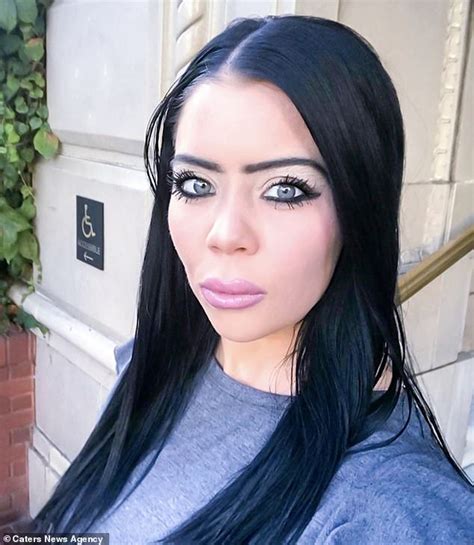 Mother Of Two Is Left With Pus Filled Blue Lips After Botched Fillers