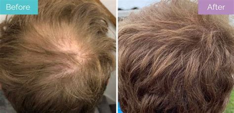 Crown Hair Transplant Procedure Recovery Success Rate Longevita