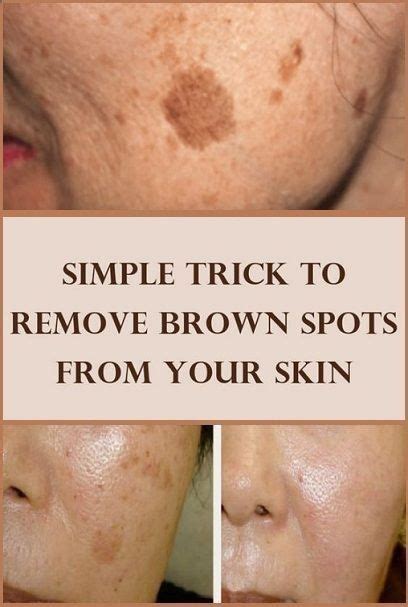 Causes Of Brown Discoloration Of Facial Skin Heidi Salon