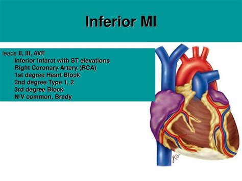 Ppt Myocardial Infarction Powerpoint Presentation Free Download Id