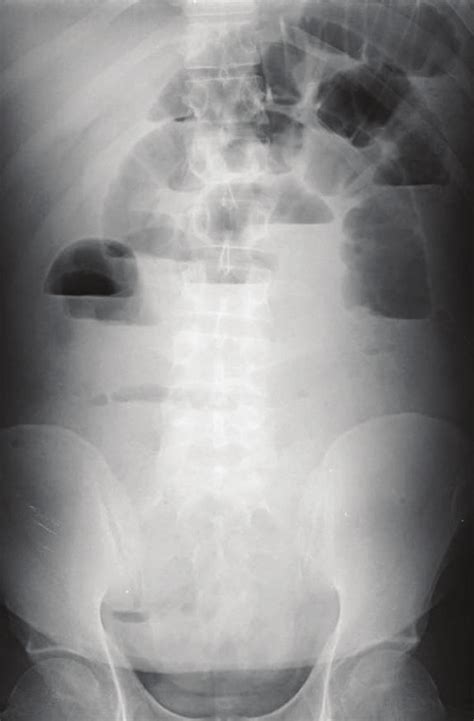 Straight X Ray Abdomen Showed Multiple Air Fluid Level In An 11 Year