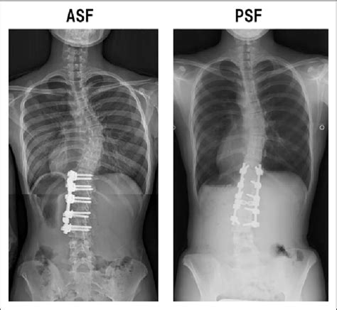 Surgery After Anterior Spinal Fusion Asf And Posterior Spinal Fusion