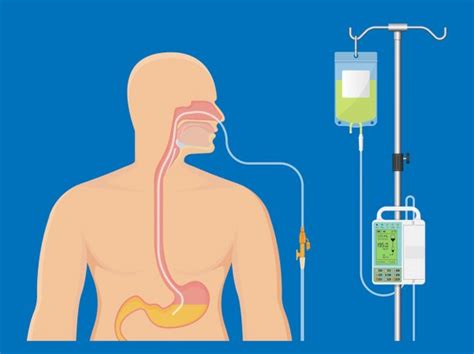 Feeding Tubes — What You Should Know Roswell Park Comprehensive Cancer Center Buffalo Ny